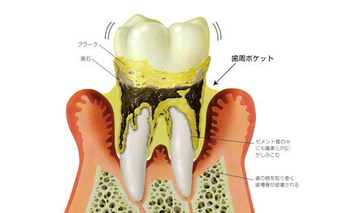 歯周病図