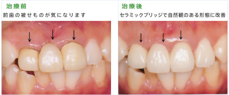 セラミックによる治療