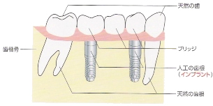 インプラント