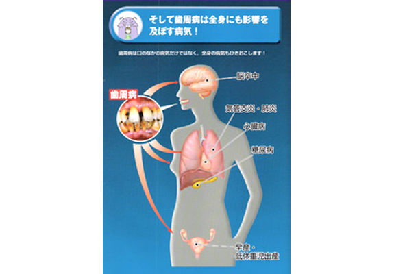 歯周病が及ぼす病気