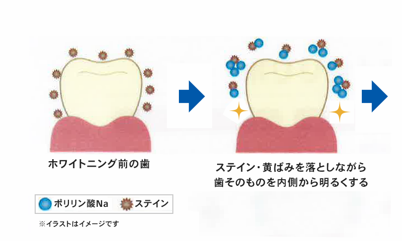 ポリリンホワイトニング